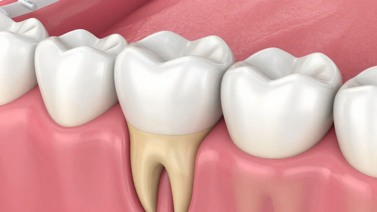 Ilustrace ústupu dásní a odhalení kořínku zuba.